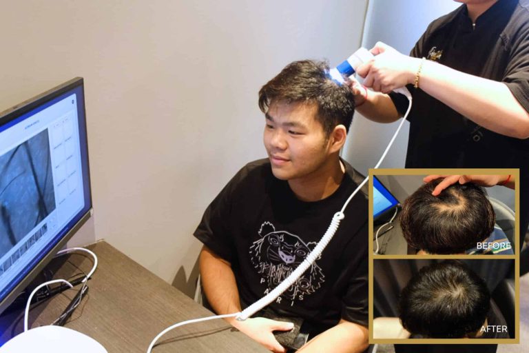 Reverse Balding with Our Hair Loss Treatments