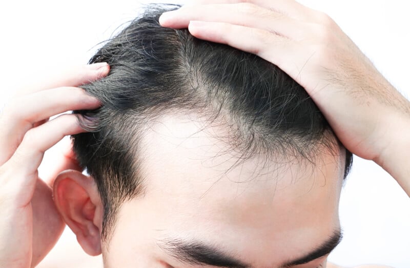 mild hair loss and hair thinning